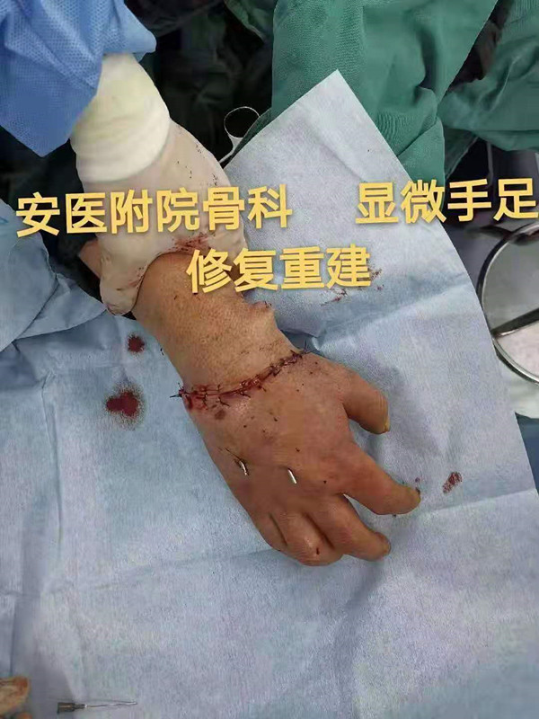 男子施工作业手腕被切断 医生7小时手术为其接回